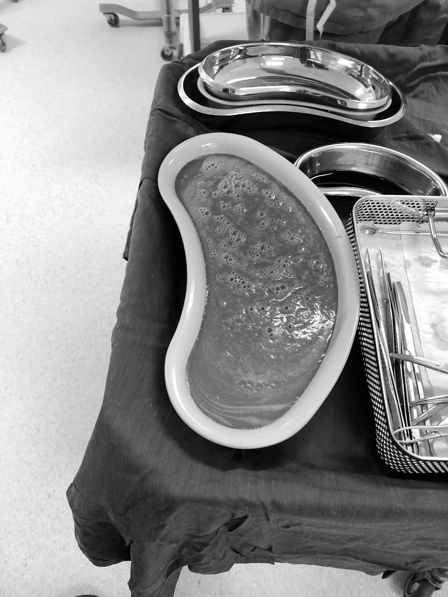 THREAD Hi Grog ChampsI drained a 2.25 Litre Liver Abscess today from a LadyYes that’s the first 1L in the big kidney dishLiver abscesses is mainly seen in Grog drinkers, usually male, unusual for a female but since both sexes entertain grog regularly now...