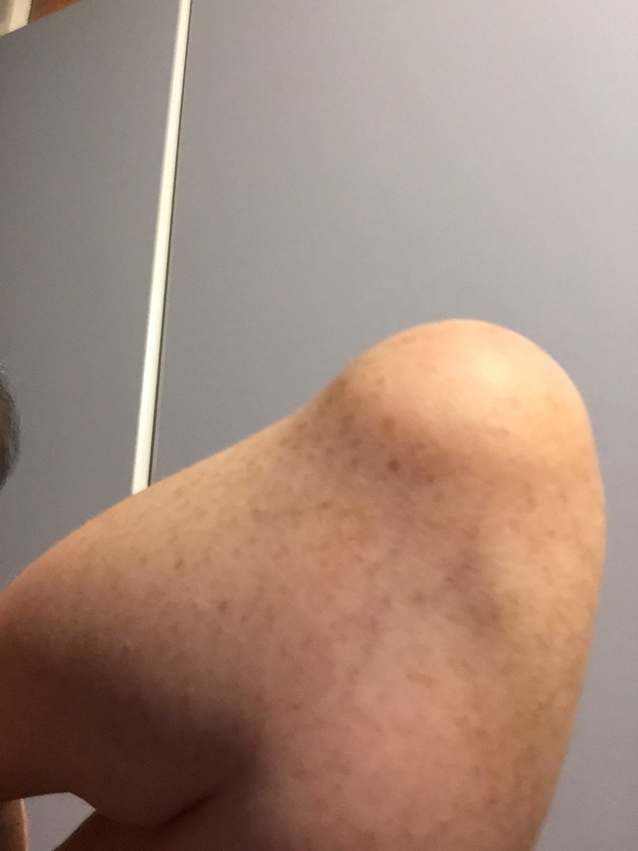 MelDrewett's tweet photo. @MamaDoctorJones do I need to see my doctor or will it clear up on its own? https://t.co/9IwUaAcmOH