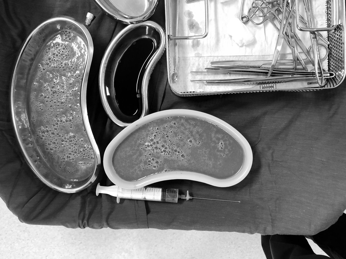 And if u start to have symptoms Come early to hospitalDon’t wait 1-5 months and then come like my two patients todayYes those are separate from the first picture Can you imagine If that abscess ruptured inside the abdomenExactly