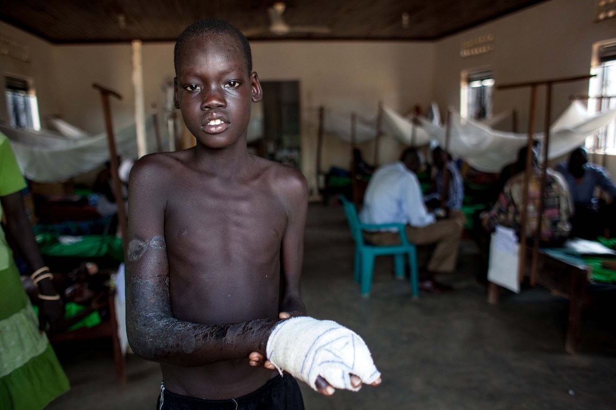 Despite daily surgical procedures to debride the dead tissue, we ended up having to amputate the affected limb.I will never forget how incredibly courageous that young boy was. He was one of the 6,000 snakebite patients  @MSF treats each year.