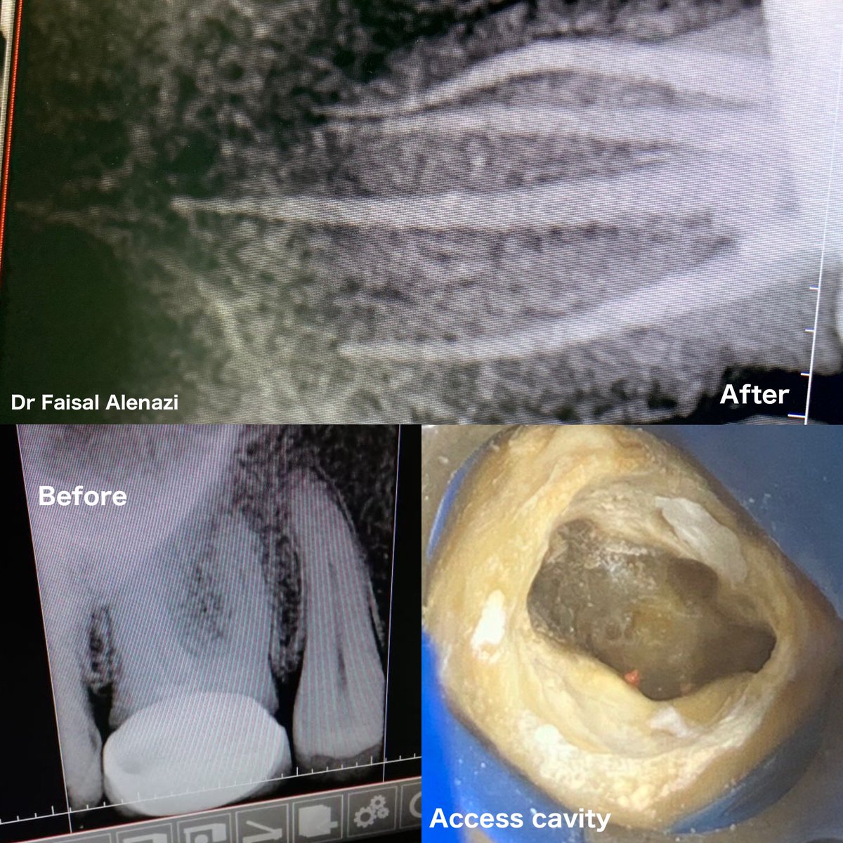 dr_fi9's tweet photo. Patient chief complaint:sever pain in upper right quadrant
Diagnosis previously treated upper first molar
Treatment plan:crown removal+re-rct
Canals were prepared with protaper next and filled with single cone technique
شكرا للدكاترة ع مساعدتهم 
@DrDoumani 
ahmed Radha 
@iNash__ https://t.co/dcuA23Rm1I