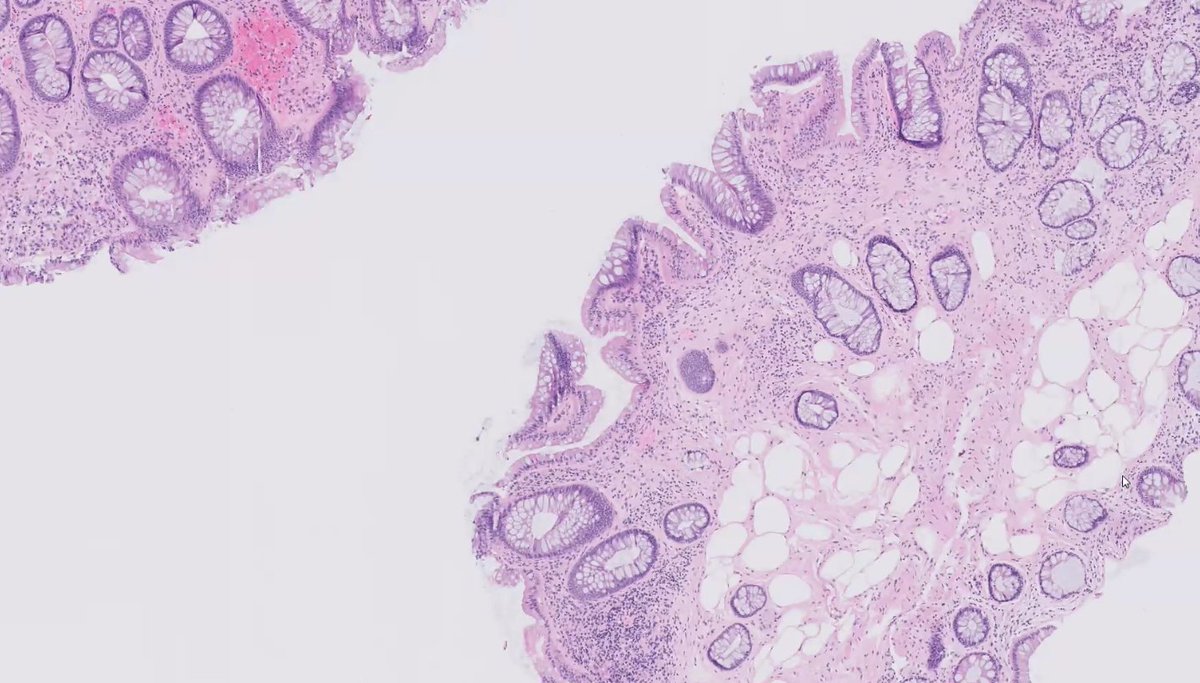 TimBell_Path's tweet photo. 34F with multiple colon polyps, macrocephaly, and trichilemmomas on face and neck.  Colon biopsy is shown below.  

What is the most common mutation seen in this syndrome?
@KMirza #TwitterHomework https://t.co/Av4wbAcezq