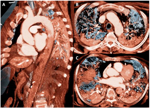 Complete aortic thrombosis in SARS-CoV-2 infection: have a look on this impressive case.
doi.org/10.1093/eurhea….
#cardiotwitter, <a href="/ESC_Journals/">European Society of Cardiology Journals</a>, <a href="/escardio/">European Society of Cardiology</a>, #aorta, #thrombosis, #COVID19