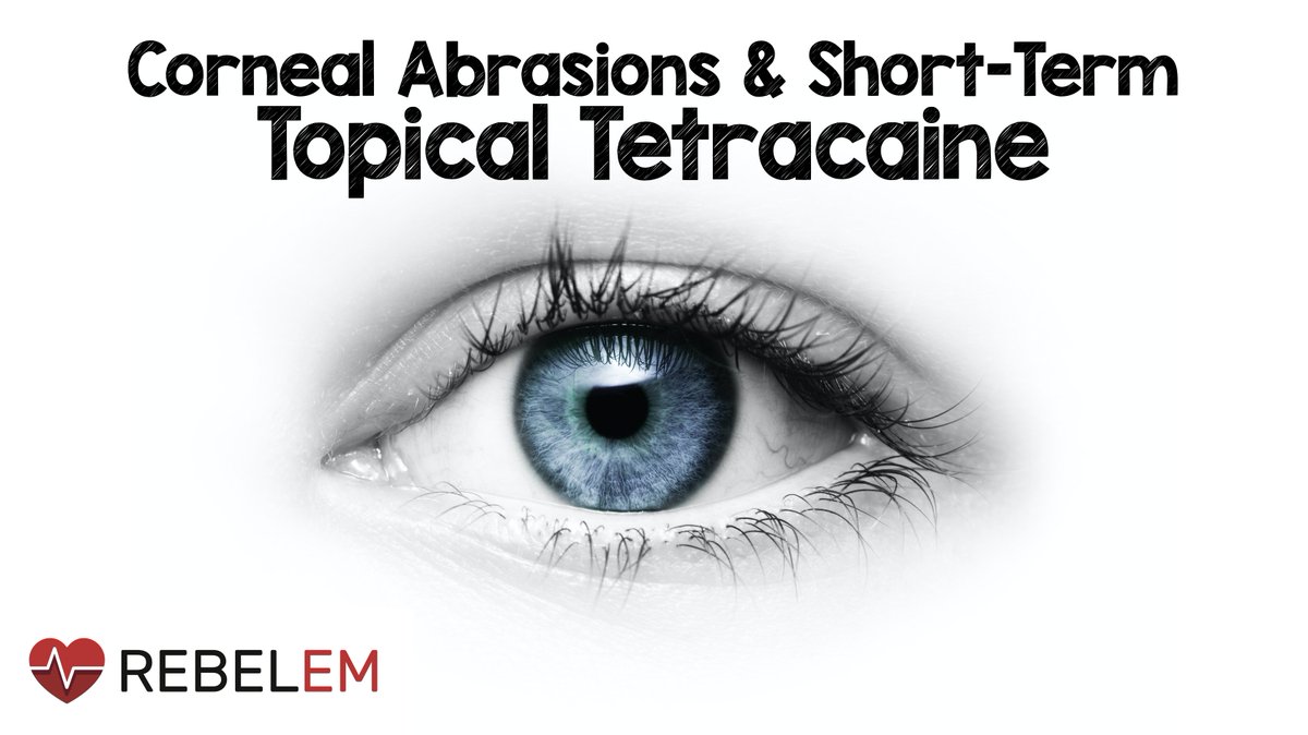 Corneal Abrasions &amp; Short-Term Topical Tetracaine

-RCT 111 uncomplicated corneal abrasions
-Tetracaine reduced pain &amp; opioid sparing vs placebo (artificial tears)
-Trial too small to rule out rare adverse events
-24 to 48hr follow up is KEY

rebelem.com/corneal-abrasi…

#FOAMed