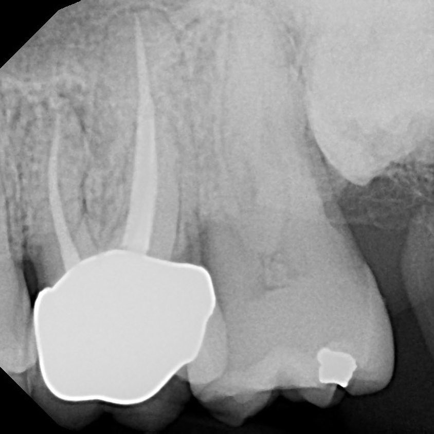 Edgardelchaar's tweet image. Just received and just placed.... extraction of first maxillary molar, osteotomy, followed with crestal sinus elevation and smooth placement and excellent primary stability...  #straumann #straumannimplants #straumanntlx #innovation #dentalimplants #implantdentistry #periodontics