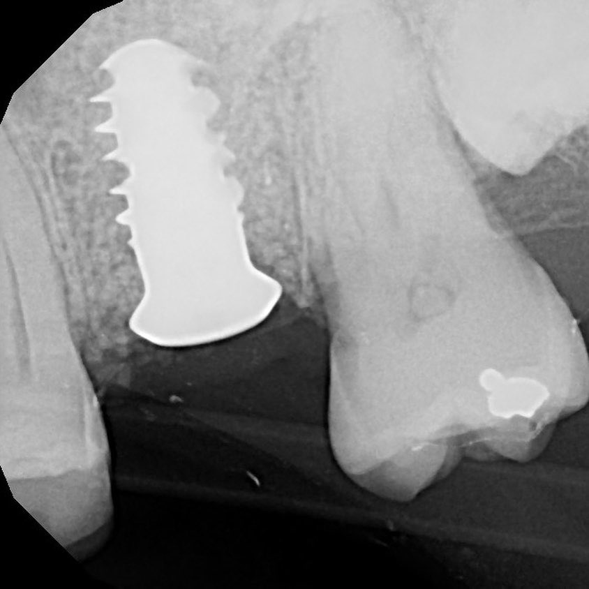 Edgardelchaar's tweet image. Just received and just placed.... extraction of first maxillary molar, osteotomy, followed with crestal sinus elevation and smooth placement and excellent primary stability...  #straumann #straumannimplants #straumanntlx #innovation #dentalimplants #implantdentistry #periodontics