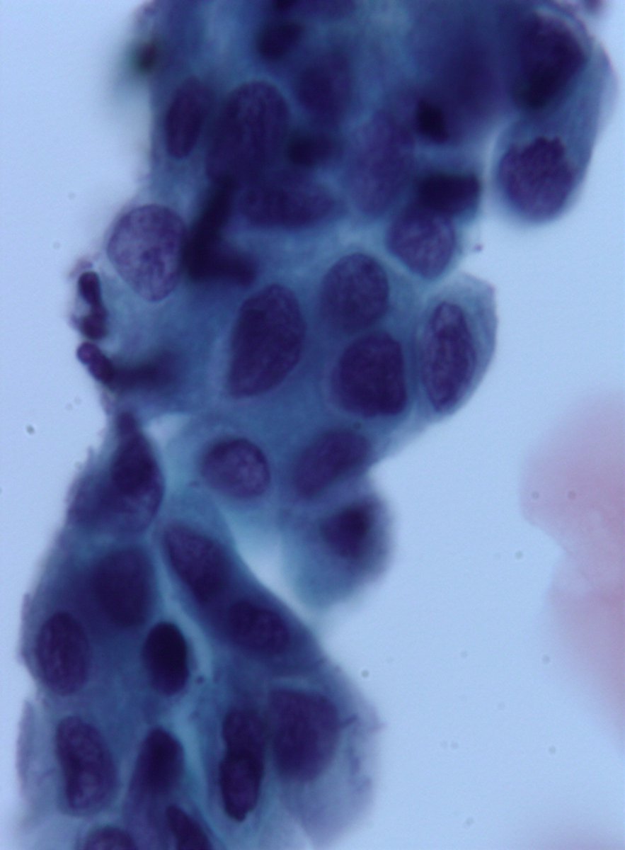 January is cervical cancer awareness month. Each year, &gt;13000 women are Dx with cervical Ca and &gt; 4,000 die. We cytopathologists play our role in finding these atypical cells, detecting cancer at its earliest. "Saving life one cell at a time" .Pic2 beware of the"litigation cells"
