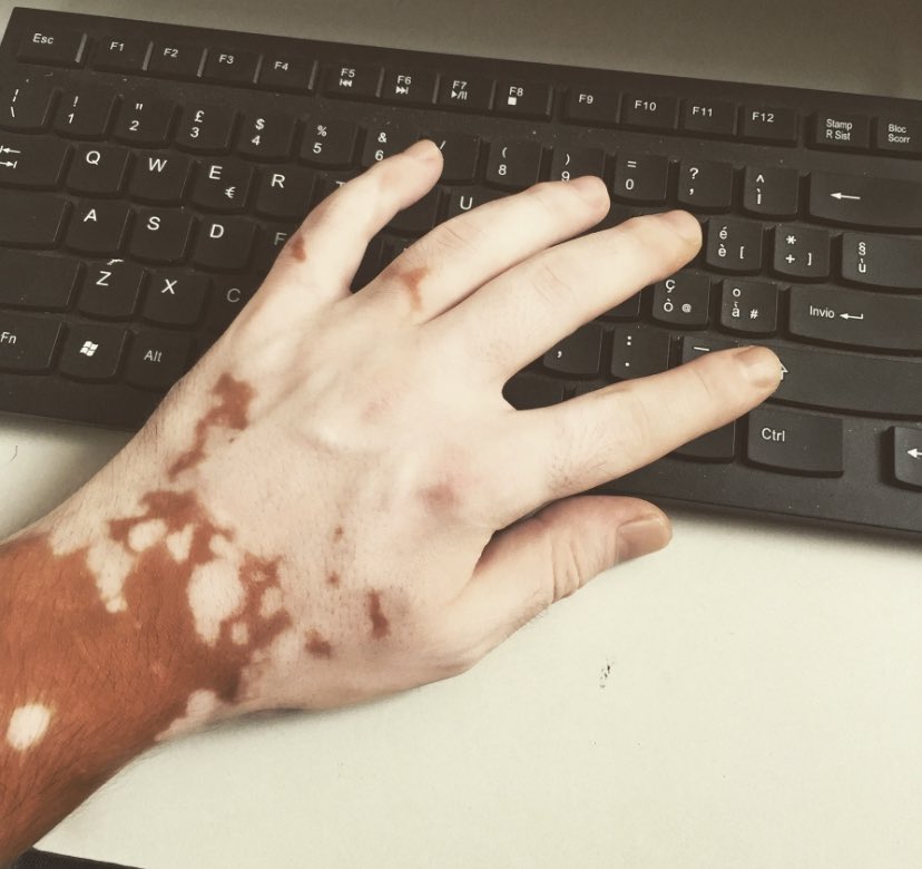 PinaKoteca_'s tweet image. #vitiligine #macchie