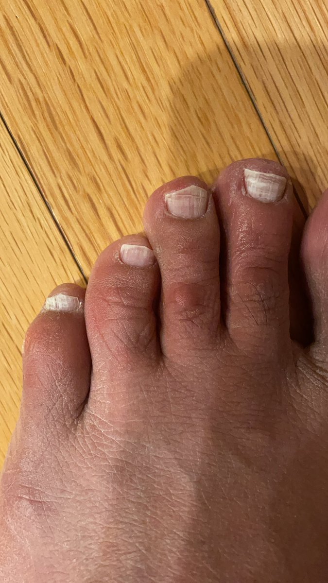 RespectAndLearn's tweet image. Are there any studies of #covidtoes underway? Asking for a friend who has itchy toes and a rash on toes for about 10 days.