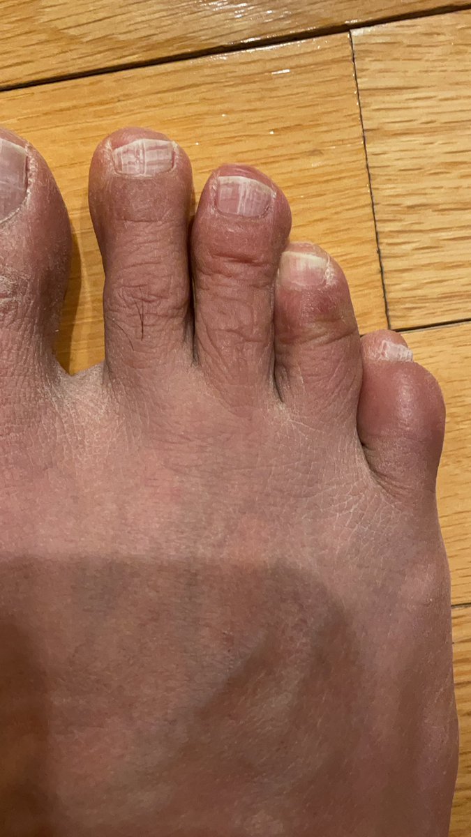 RespectAndLearn's tweet image. Are there any studies of #covidtoes underway? Asking for a friend who has itchy toes and a rash on toes for about 10 days.