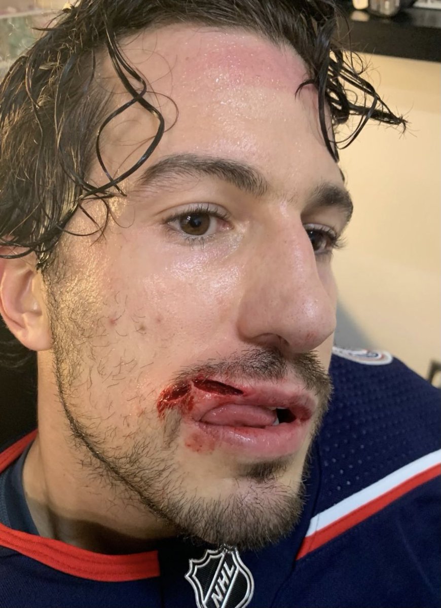 CBJcenter's tweet image. *GRAPHIC*

Del Zotto’s got a little cut...😳😳 #CBJ