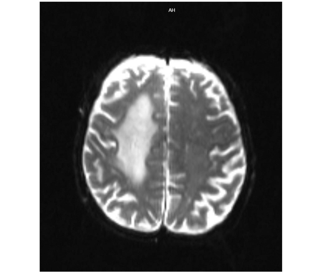 📌#fridaywithTurkJColorectalDis
ArticleTitle: Small Bowel Adenocarcinoma Presenting with Brain Metastasis
“The most common presenting symptom is intermittent and crampy abdominal pain”
Type: Case Report
#Adenocarcinoma #brainmetastasis #cancer #smallbowel

turkishjcrd.com/archives/archi…