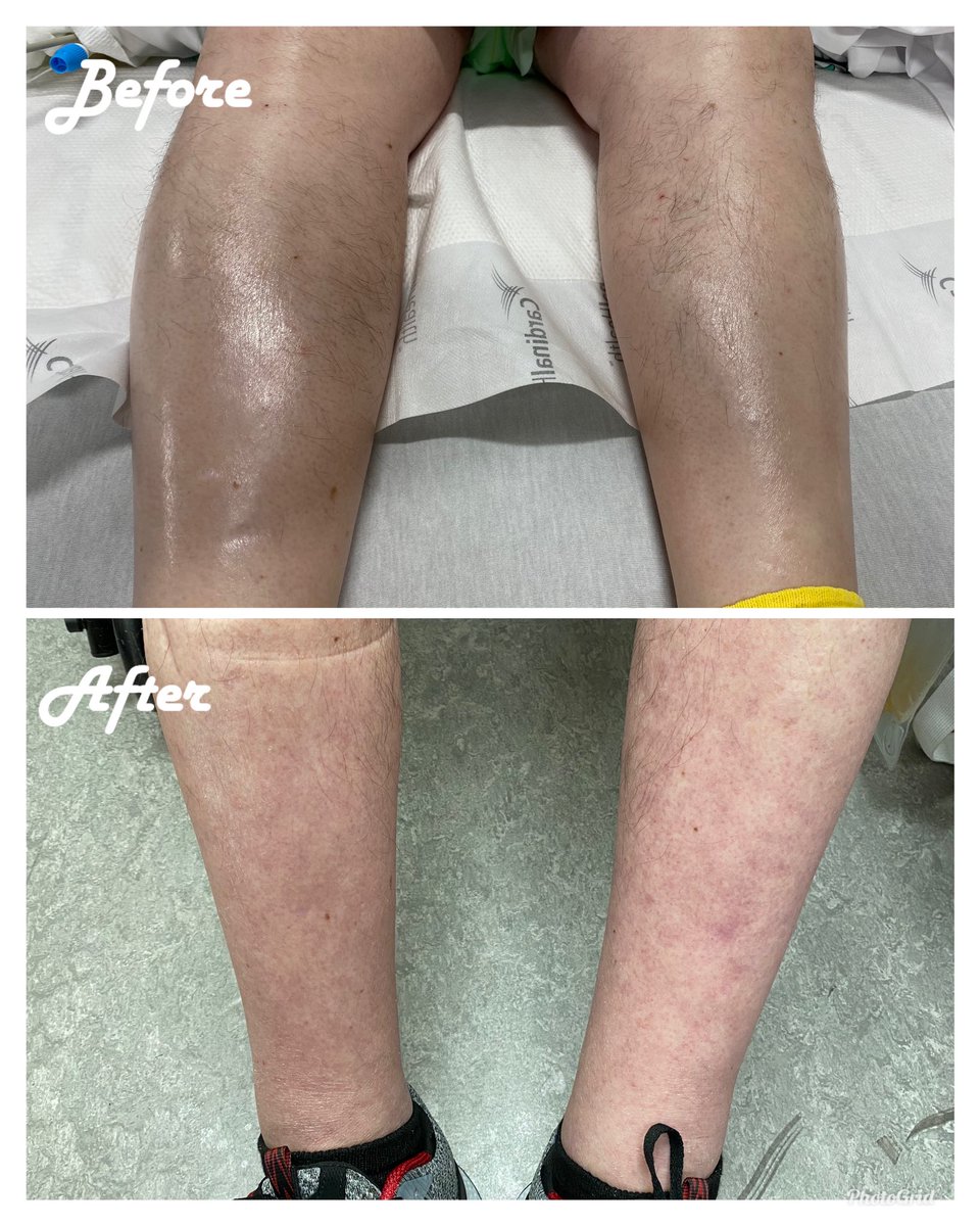 Mamdouh Khayat (@mamdouhkhayatmd) on Twitter photo 72-year-old presenting with edema and inability to ambulate from pain; extensive iliocaval thrombus caudal to filter placed at OSH. Successful #FilterOut and mechanical thrombectomy. No thrombolytics or ICU required ⏳ <a href="/SIRspecialists/">Society of Interventional Radiology</a> <a href="/SIRRFS/">SIR RFS</a> <a href="/InariMedical/">Inari, now part of Stryker</a> 72-year-old presenting with edema and inability to ambulate from pain; extensive iliocaval thrombus caudal to filter placed at OSH. Successful #FilterOut and mechanical thrombectomy. No thrombolytics or ICU required ⏳ <a href="/SIRspecialists/">Society of Interventional Radiology</a> <a href="/SIRRFS/">SIR RFS</a> <a href="/InariMedical/">Inari, now part of Stryker</a>