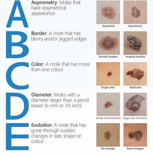 Elizabe28913853's tweet photo. Had a mole removed from my back a few weeks ago; there were 'abnormal cells' present - but they are gone now! Know your moles and look our for these signs. Prevention better than cure! @AlCRIproject @ULCancerNetwork https://t.co/7sXTo83sOE