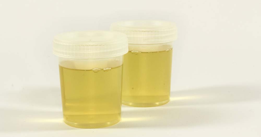 Нормальный цвет мочи. Зеленоватая моча. Цвет мочи зеленовато-желтый. Почему у мочи зеленоватый цвет. Темная моча при панкреатите.