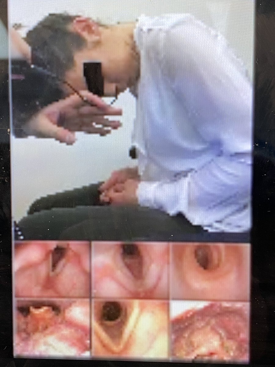 Tips and tricks for reviewing airway imaging and discussing the future in virtual reality in our last expert session. Apt for a virtual conference! #laryngealdistraction @GAMCLondon2021 <a href="/ann_barron1/">Ann Barron</a> <a href="/RezaNourai/">Reza Nourai</a> <a href="/Consult_ENT/">Karan Kapoor</a>
