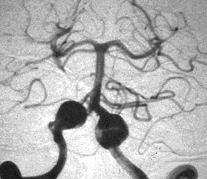 cvsection's tweet photo. #Giant #fusiform #aneurysms in posterior circulation may have several options for treatment - immediate proximal parent artery occlusion, remote proximal artery occlusion, clip reconstruction, distal #bypass @CNS_Update @NeurosurgeryCNS @MayoNsgy @MayoClinicNeuro @MayoClinic https://t.co/EQE5T3cAYs