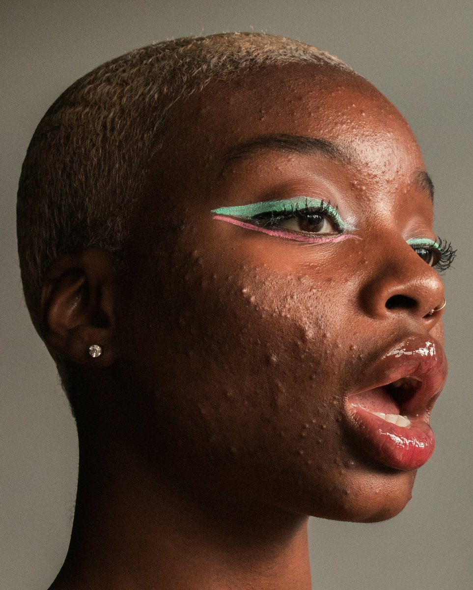peter_devito's tweet photo. Hi, my name is Peter DeVito &amp; I’m a photographer who takes pics of ppl w/ acne &amp; other ppl who I don’t think are represented enough to try &amp; show how there’s beauty in everyone. If you’ve ever seen either of these pics before, I’m the one who took them:) https://t.co/JnONIfUmAk