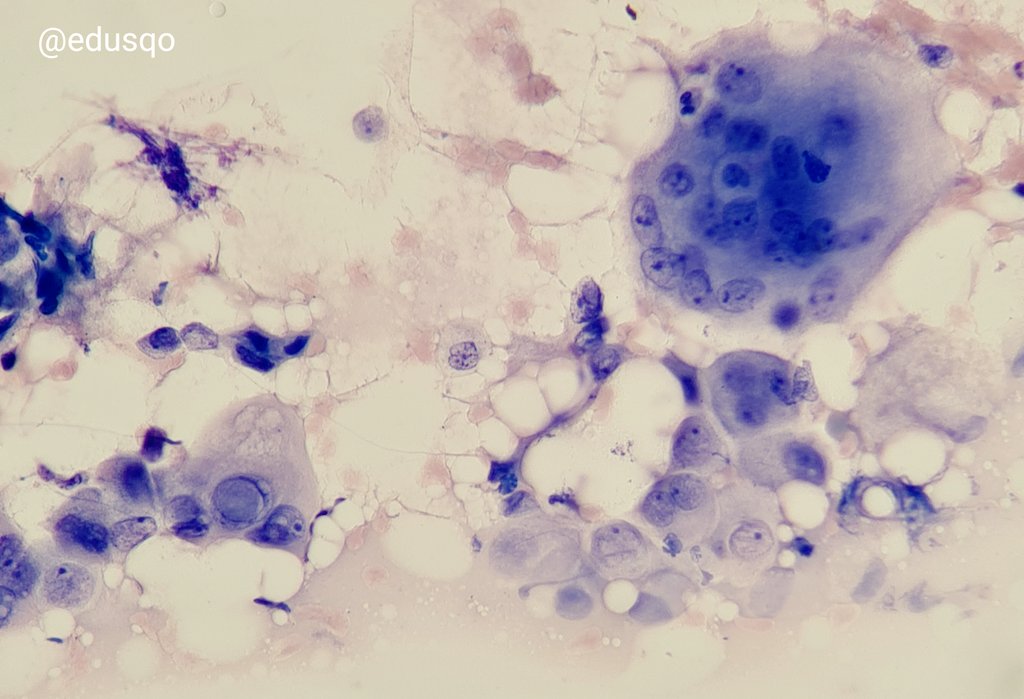 edusqo's tweet photo. #Giemsa #HE #Papanicolaou #DiffQuik...it is the same.
#PTC #FNAFriday #EndoPath https://t.co/SAjLY05C49