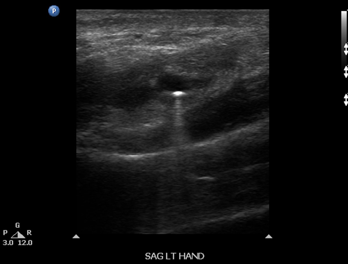 Acute BB gun injury with retained pellet to hand
