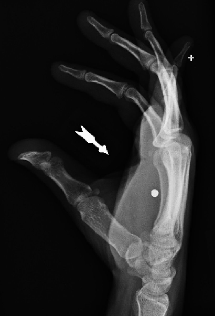 Acute BB gun injury with retained pellet to hand
