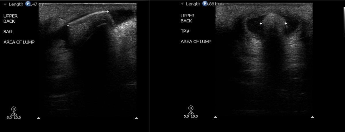 Remote bullet wound--2 years ago. Patient admits to repetitively rubbing it and states it feels irritated/painful so presented to ED.