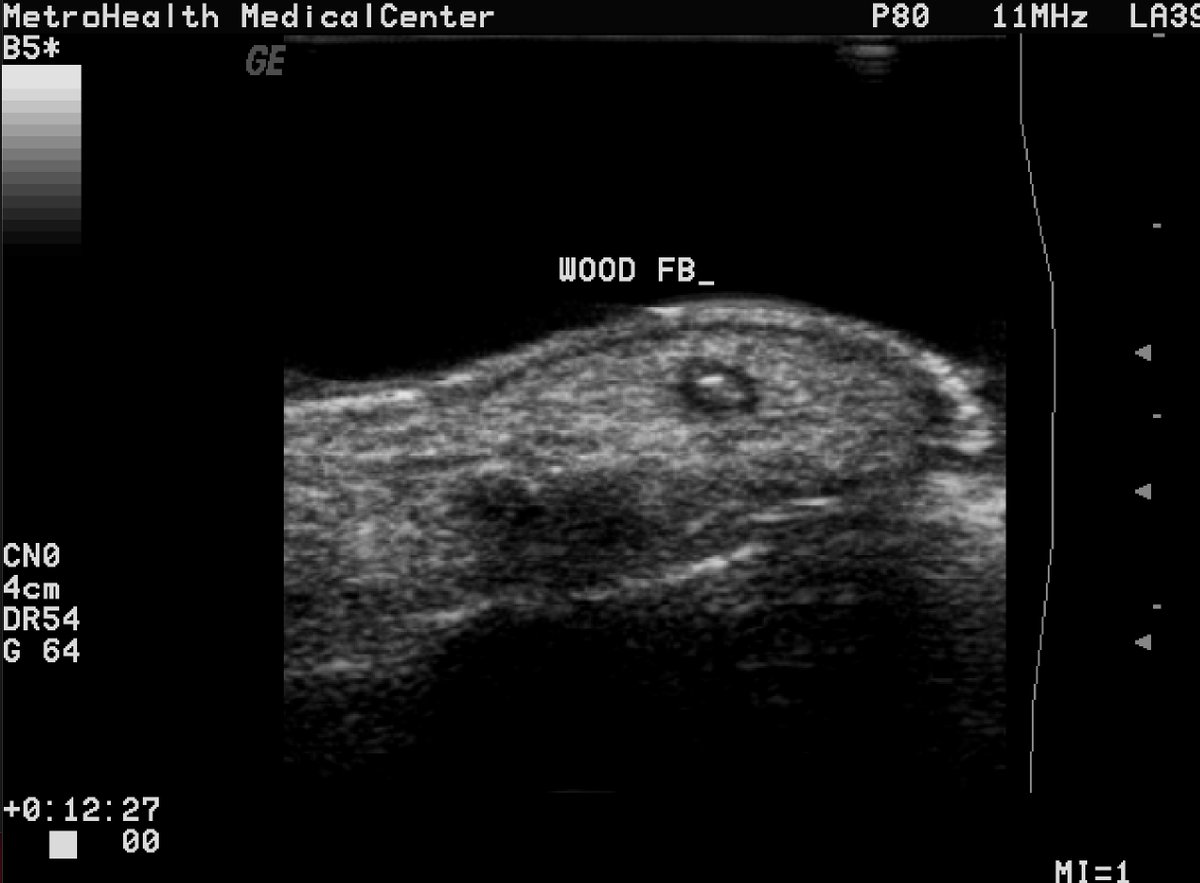 Retained wood splinter with halo seen. Same case from above where removal shown. Standoff pad used.