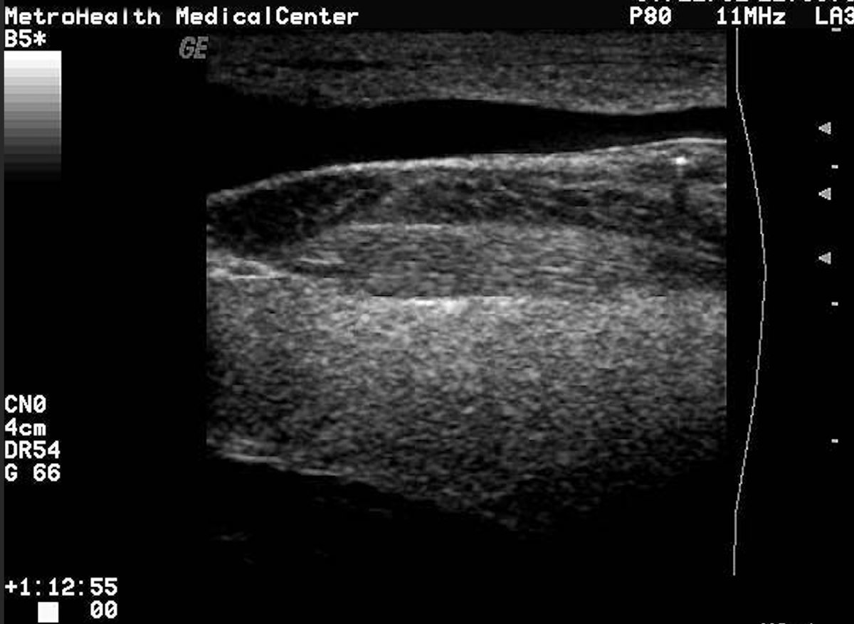 Broken needle seen posterior to EJ. Startled during police raid while injecting and needle broke off. FB seen short axis with posterior reverberation.