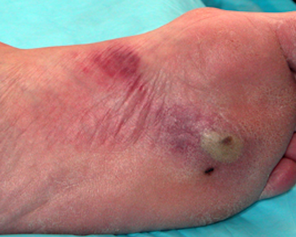 Stepped on something 10 days ago now with cellulitis, abscess, lymphangitis.