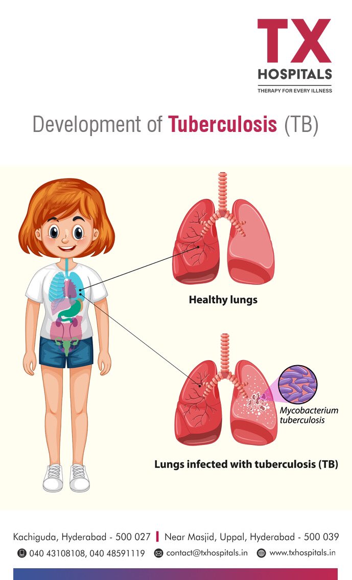 Mycobacterium Tuberculosis 
#mtb #MycobacteriumTuberculosis #tuberculosis #bestpulmonologist #bestpulmonologyhospitalsinhyderabad #bestmultispecialityinhyderabad #bestlungsspecialistinhyderabad #Lungdisease #LungsHealth #bestmultispecialityinUppal txhospitals.in