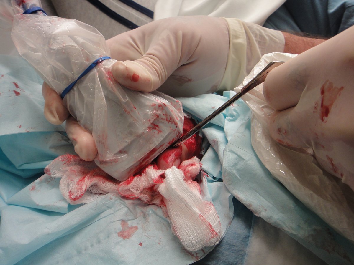 Clinical image of wood FB removal from finger with alligator forceps.