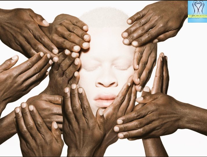 The_Tonga_Queen's tweet photo. The Queen's Diaries
#LETSENDDISCRIMINATION
Every Saturday l will be sharing the sad stories about discrimination happening around the country within the albino community. Today l will post a screenshot from one of the Albinism Konect WhatsApp groups https://t.co/kU7prGXial