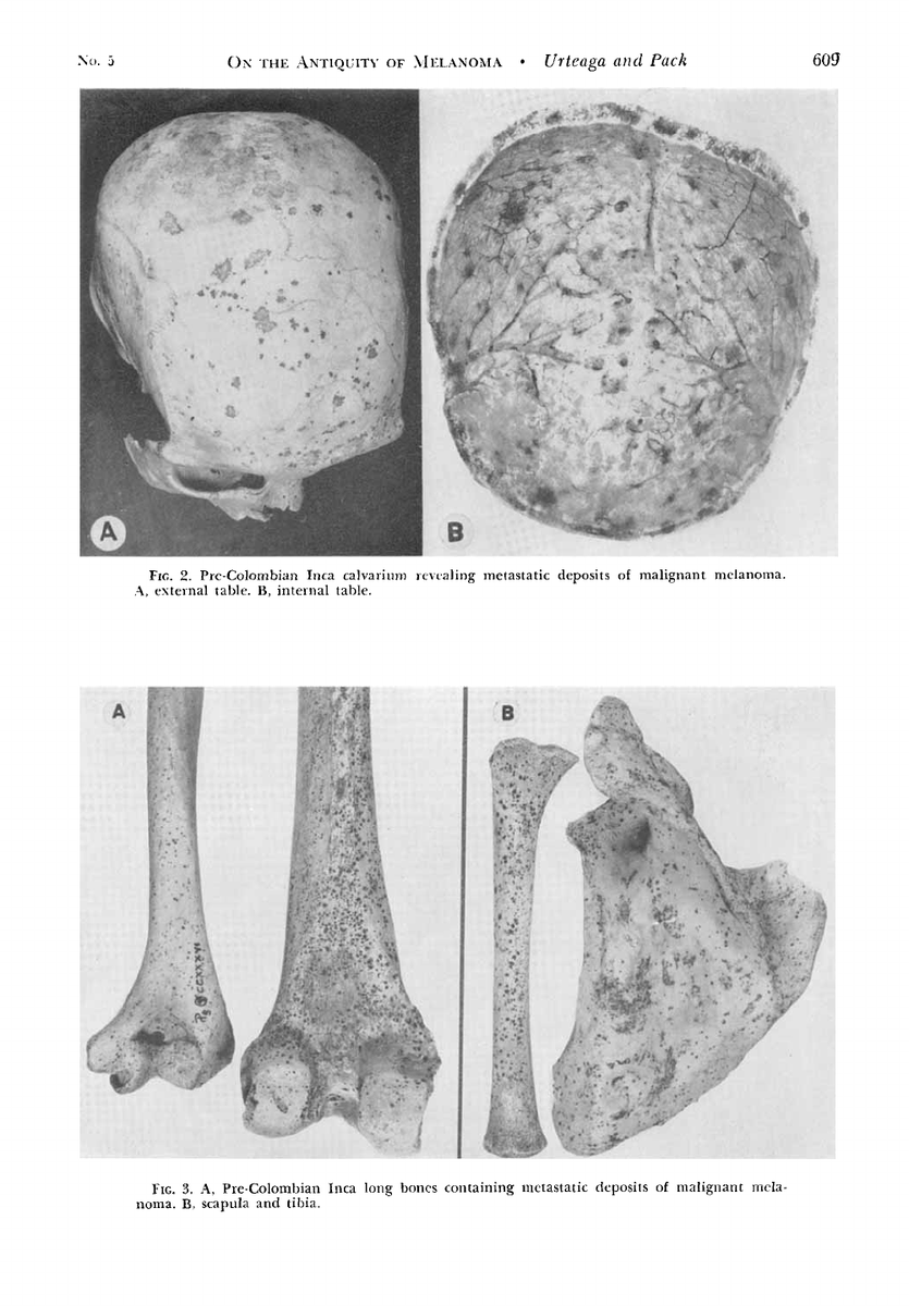 3/4. Peru.Peruvian mummies, dating back over 2,400 years, were shown to have metastatic deposits with numerous skin lesions.Below is an image (with reference).Urteaga B., O. and Pack, G.T. (1966), On the antiquity of melanoma. Cancer, 19: 607-610.