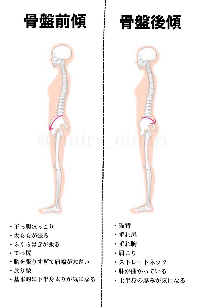 トレえみ 骨盤 の前傾後傾がそもそもわからない という声があったのでどちらに傾くと前傾か後傾かイラストにしておきます 昨日ツイートした脚の開き具合で骨盤を見た方でこの2つに当てはまる方 この様な問題はないでしょうか