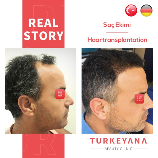 TurkeyanaClinic on Twitter: TurkeyanaClinic on Twitter: