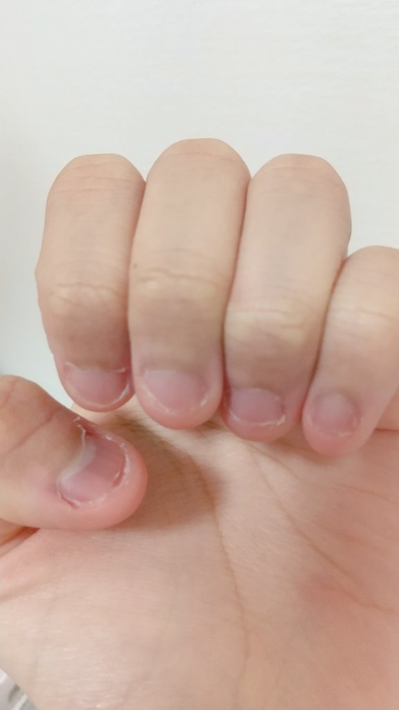 咬爪症 咬爪症