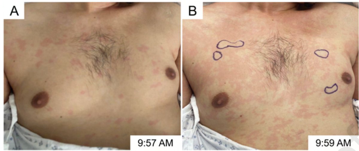 Yale Dermatology (@yalederm) on Twitter photo A cool report of rapidly migratory erythema from @nelsonugwuc <a href="/JeffGehlhausen/">Stacy Muun</a> #IrwinBraverman and #JeanBolognia
jaadcasereports.org/article/S2352-⦠A cool report of rapidly migratory erythema from @nelsonugwuc <a href="/JeffGehlhausen/">Stacy Muun</a> #IrwinBraverman and #JeanBolognia
jaadcasereports.org/article/S2352-ā¦