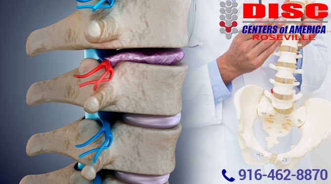 #BulgingDiscsTreatmentAlternativesRosevilleCA Call @ 916-462-8870 or see here: bit.ly/2Jt7yZe