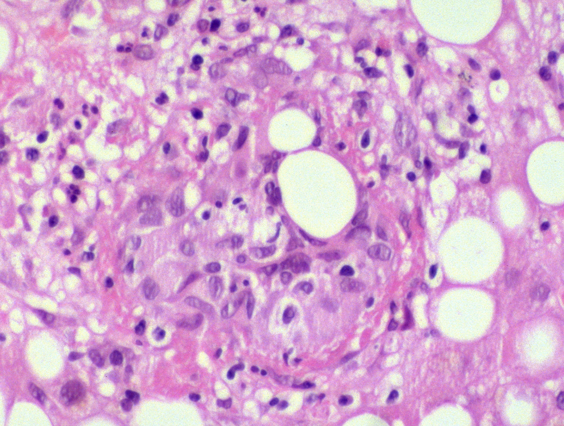 Yale Rosen on Twitter: "Fibrin ring granulomas are rare, occurring mostly  in liver and bone marrow. Best known for occurrence in Q fever but also  reported in EBV, visceral leishmaniasis, toxoplasmosis, Hodgkin