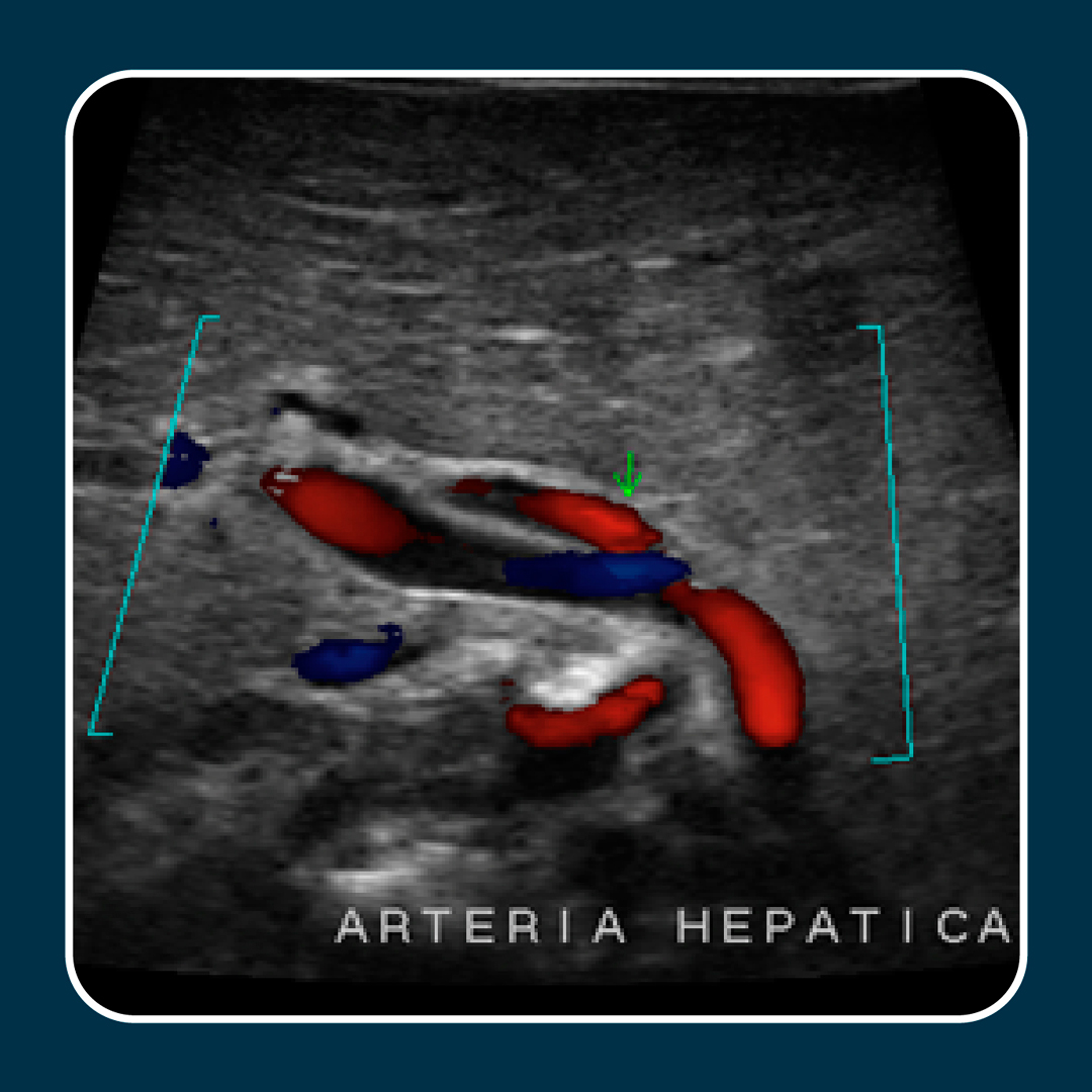 escuelacentrus's tweet photo. #WEBINAR 19 de enero 2021
Atresia de vías biliares
Aproximación diagnóstica por ultrasonido y doppler 
.
Hora:
7:00 pm - PE - ECU - CO
.
✔️ Registrese en:
https://t.co/cvUtkeVkoV
.
✔️ Dr. Pedro Unshelm
- Médico Radiólogo.
.
👉 Se entregará Certificado de participación https://t.co/w8Z93NZ0RC