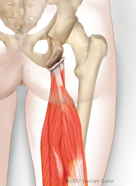 nashvilleorthos's tweet photo. Acute rupture of the #hamstring tendon from the #ischium can occur & is usually caused by a fairly violent force. This can occur by many different mechanisms, although the classic example is a #waterskiing accident where the skier tries to...https://t.co/cUdibbfClN #orthotwitter https://t.co/TQcNP5oBuy