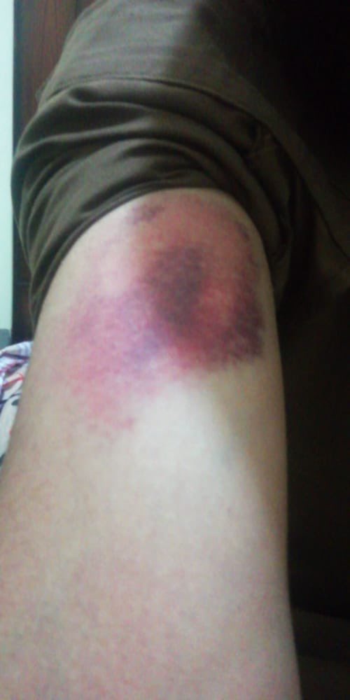 MiRae81603204's tweet photo. Physical abuse by our country’s police, killing youth. God forbid you all will see the consequences. No rank stays forever. Rector will pay for what he did. #NumlStudentskidnapped #NUMLians_under_Police_torture #StudentsRejectPhysicalExams #RectorNuml_IsResponsible_ForThisMess https://t.co/LmrShsfUic