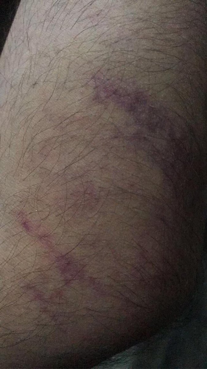 MiRae81603204's tweet photo. Physical abuse by our country’s police, killing youth. God forbid you all will see the consequences. No rank stays forever. Rector will pay for what he did. #NumlStudentskidnapped #NUMLians_under_Police_torture #StudentsRejectPhysicalExams #RectorNuml_IsResponsible_ForThisMess https://t.co/LmrShsfUic
