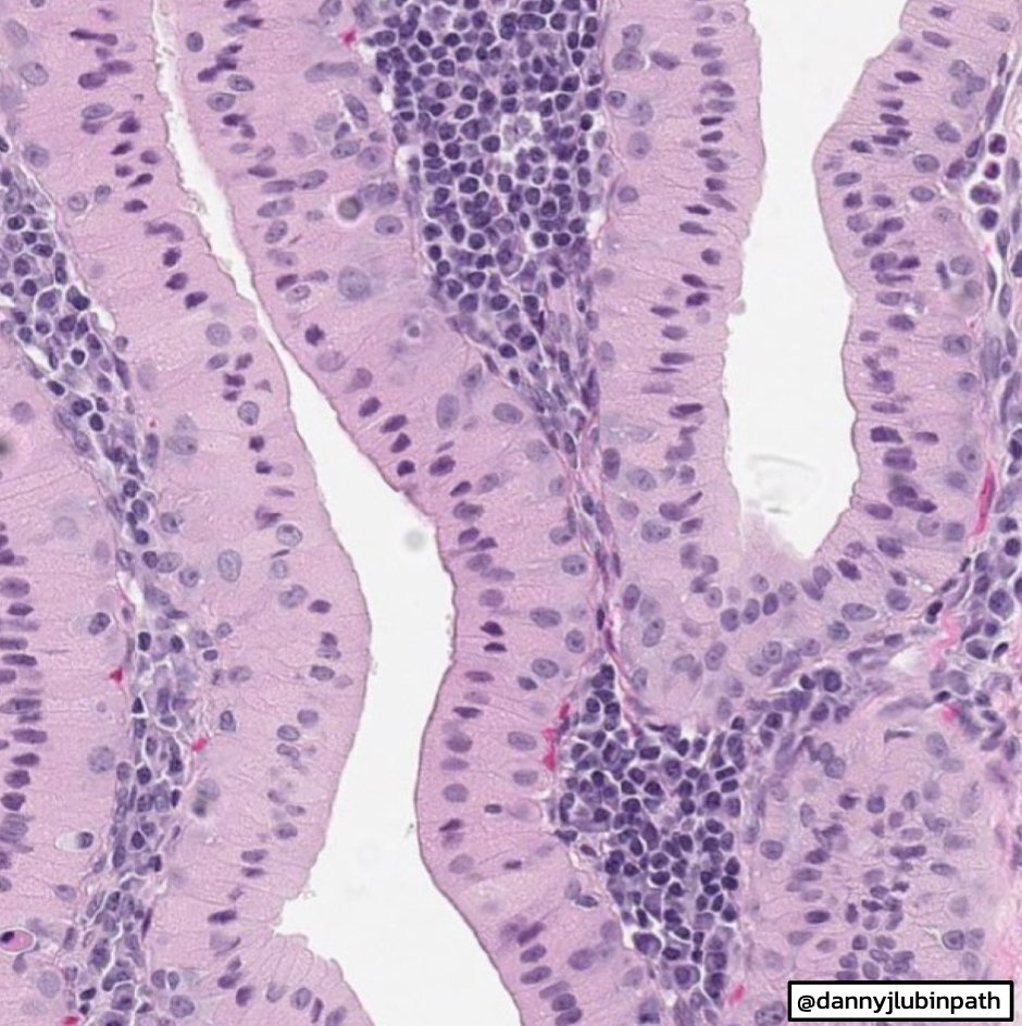 EmoryPathology's tweet photo. 🔬EMORY CASE OF THE WEEK #21:

80 y/o F w/ a 50 pack year smoking history presents with bilateral PET-avid parotid masses.

Answer the question below!

Contributor: @dannyjlubinpath

🚨 WARNING: video has flashing (strobe-like) lights 🚨

#entpath #EmoryCoTW #emorypathres https://t.co/PRfYbtNQpR