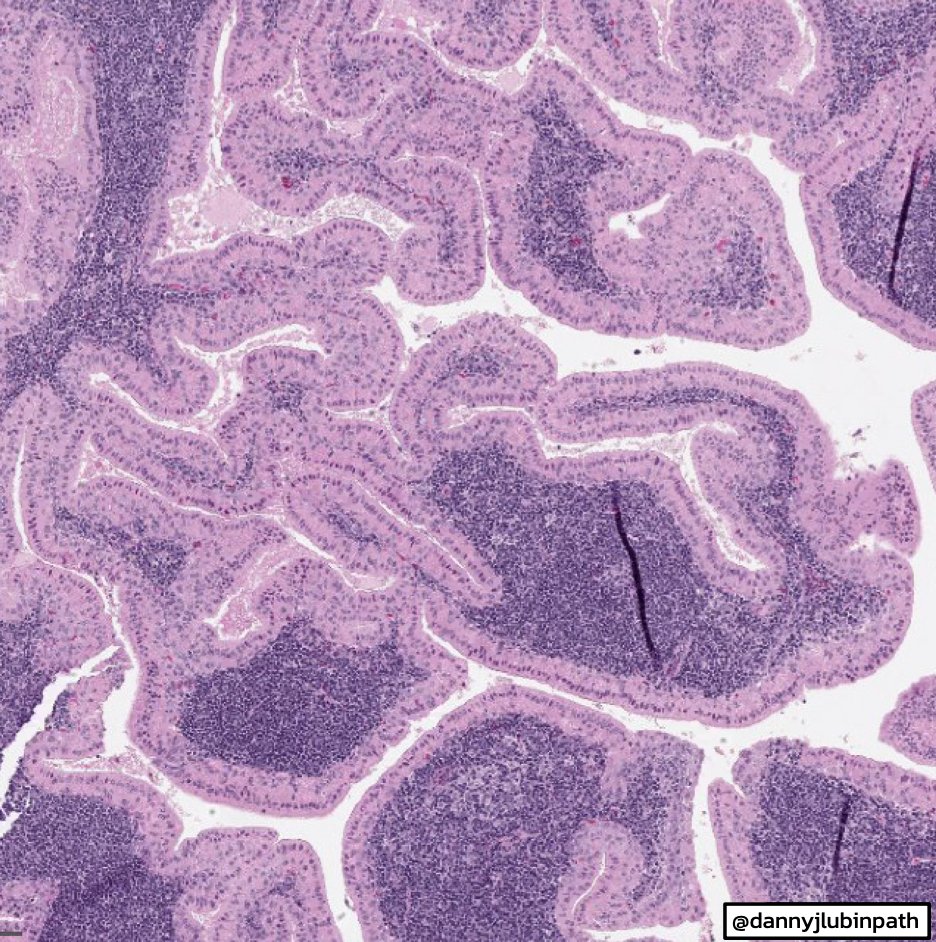 EmoryPathology's tweet photo. 🔬EMORY CASE OF THE WEEK #21:

80 y/o F w/ a 50 pack year smoking history presents with bilateral PET-avid parotid masses.

Answer the question below!

Contributor: @dannyjlubinpath

🚨 WARNING: video has flashing (strobe-like) lights 🚨

#entpath #EmoryCoTW #emorypathres https://t.co/PRfYbtNQpR