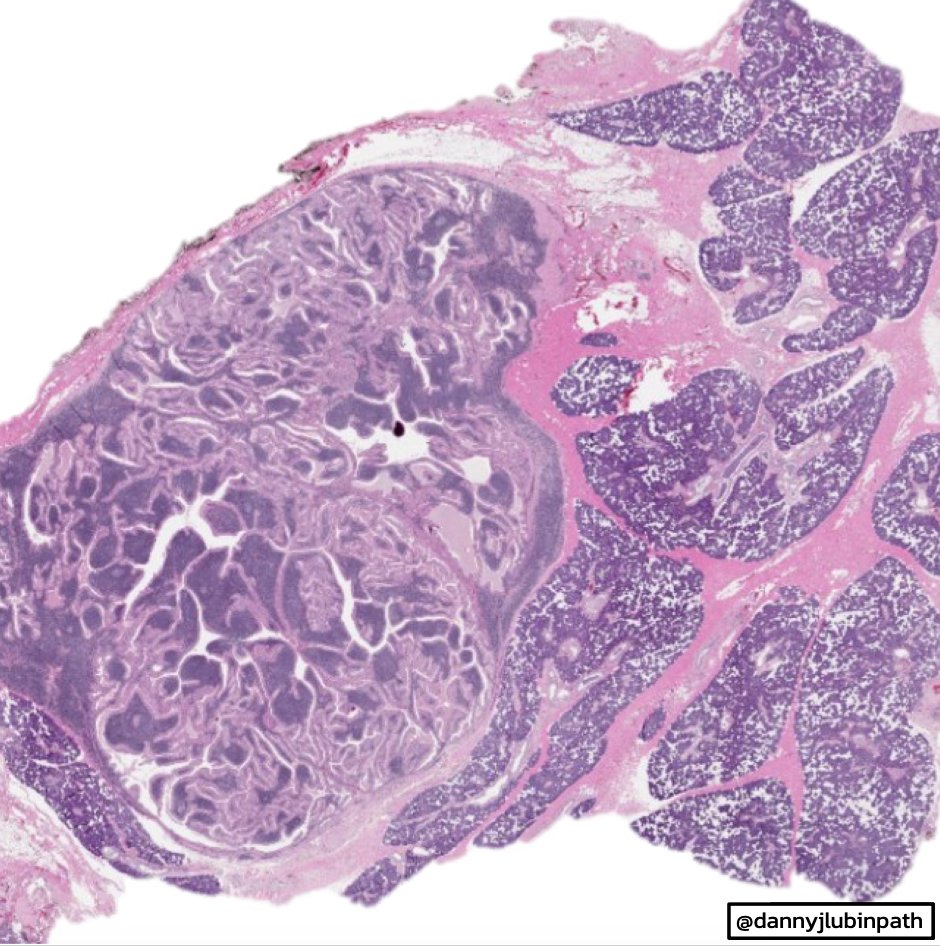 EmoryPathology's tweet photo. 🔬EMORY CASE OF THE WEEK #21:

80 y/o F w/ a 50 pack year smoking history presents with bilateral PET-avid parotid masses.

Answer the question below!

Contributor: @dannyjlubinpath

🚨 WARNING: video has flashing (strobe-like) lights 🚨

#entpath #EmoryCoTW #emorypathres https://t.co/PRfYbtNQpR