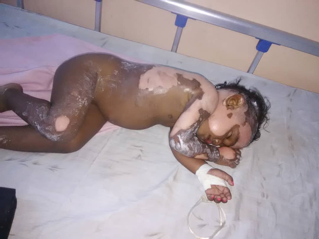 juancavillegas's tweet photo. #ayudaAtuProjimo Ashley Torrealba 1 año sufrió quemaduras con agua hirviendo #Tinaquillo necesita ayuda fue trasladada a la CHET Valencia alguna fundación o personas que puedan ayudarle @MamaLisVzla @alexagomez2000 @LuisOlavarrieta @Class987FM @alexolvera01 @AlbanoGonzalo https://t.co/ILKlRa5s4n