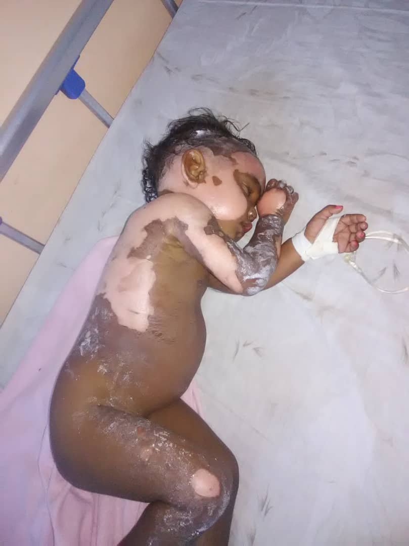 juancavillegas's tweet photo. #ayudaAtuProjimo Ashley Torrealba 1 año sufrió quemaduras con agua hirviendo #Tinaquillo necesita ayuda fue trasladada a la CHET Valencia alguna fundación o personas que puedan ayudarle @MamaLisVzla @alexagomez2000 @LuisOlavarrieta @Class987FM @alexolvera01 @AlbanoGonzalo https://t.co/ILKlRa5s4n