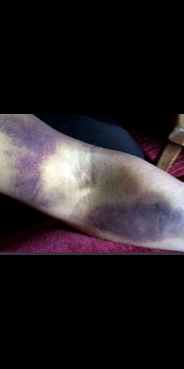 Areesha20789745's tweet photo. This is really not acceptable...
#NUMLians_under_Police_torture
#NUMLiansBoycott_PhysicalExams #NumliansReject_OnCampuExams #NumlStudentskidnapped #NumliansWantOnlineExams #Numlians #NUML_RactorMurdabad #numlrector_boycott #Numlians_boycott_FinalExams
@ShahzadYunasPTI https://t.co/JA9Pjgpsaz
