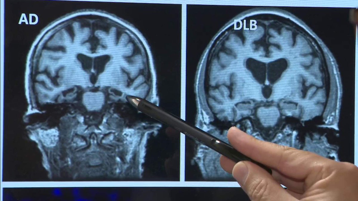 memory_health's tweet photo. Researchers work to understand how #COVID19 impacts memory https://t.co/XofIFqpfXw

Clinical trials are underway, aimed at gaining a greater understanding of how the #coronavirus impacts people with #Alzheimer’s or #dementia, and #memory loss.

 #longhaulers #memory #braingfog https://t.co/kOzwHzBW0x